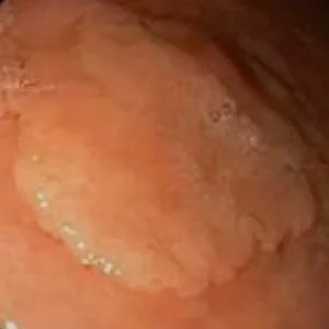 Cancer gastrico
