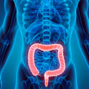 Manejo de colitis ulcerosa grave