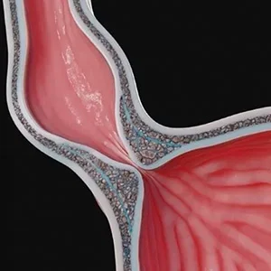 Acalasia