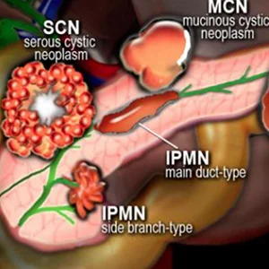 Abordaje del paciente con quiste pancreático