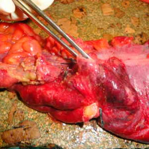 Colitis ulcerosa. Más allá de la cirugía