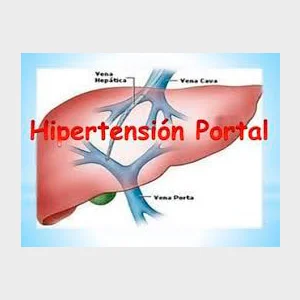 Hipertensión portal no cirrótica