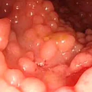 Poliposis adenomatosa familiar