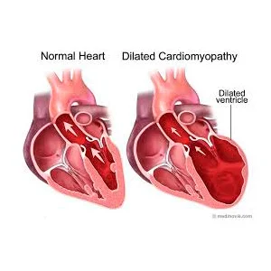 Miocardiopatia del cirrotico